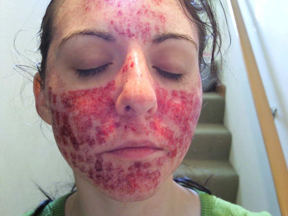 deep acne treatments cystic Adult