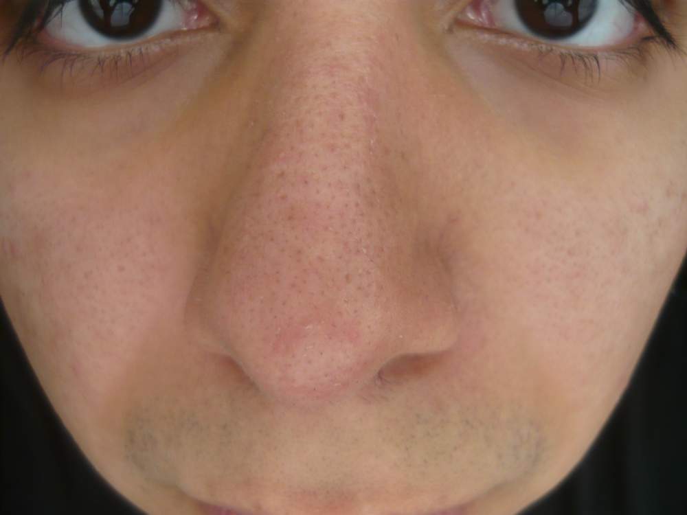 huge-pores-all-over-nose-and-face-my-crap-skin-pictures-videos