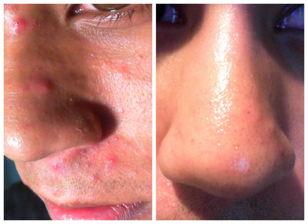 Face Close Up Nose And Upper Lip 213 Days Later Pictures