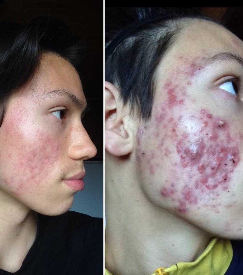 doing away with butt acne