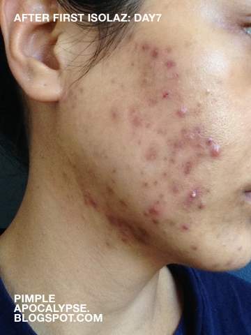 oral diflucan dosage yeast infection oral diflucan dosage yeast infection