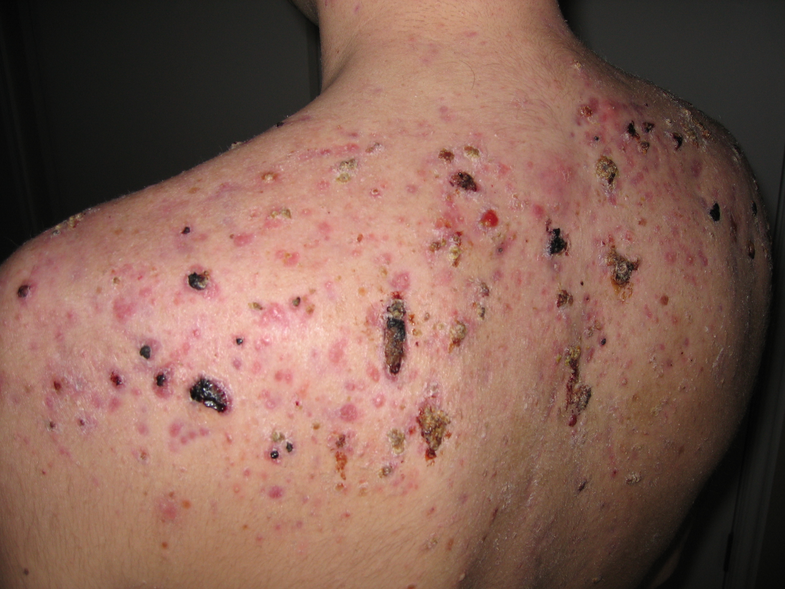Gallery for – bad pimple on back