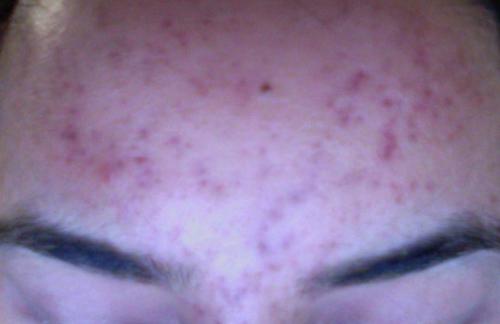 Where do I go from here? - Scar treatments - Acne.org Where do I go from here? - Scar treatments - Acne.org