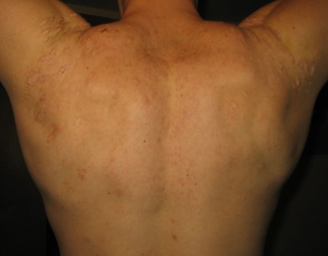 Scars On Back Chest And Shoulders Scar Treatments Community