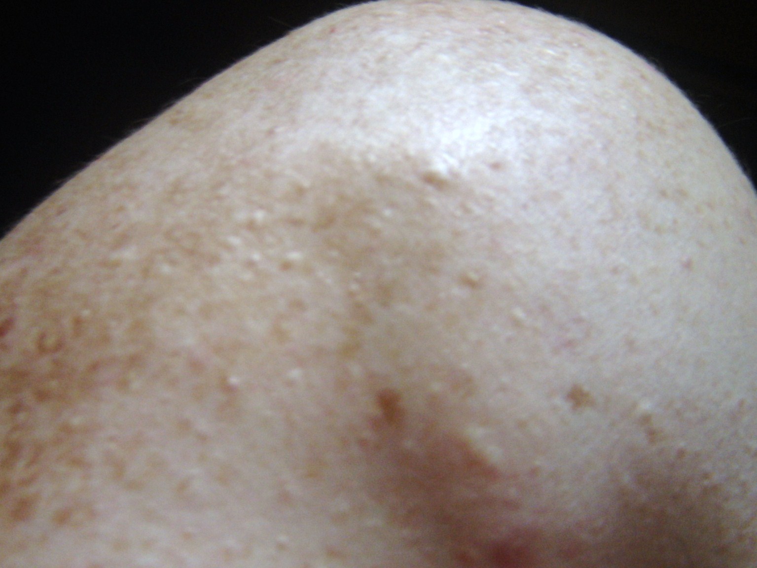 white-bumps-scar-treatments-acne-community