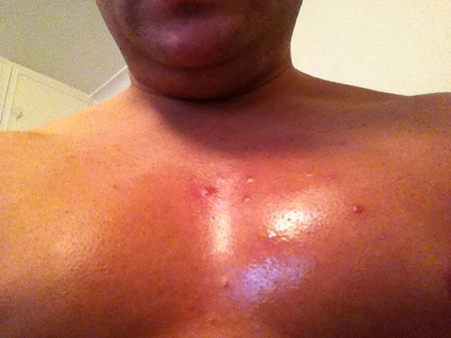 Bumps on Chest, Not Acne, Red, Itchy, White, Small, Under ...