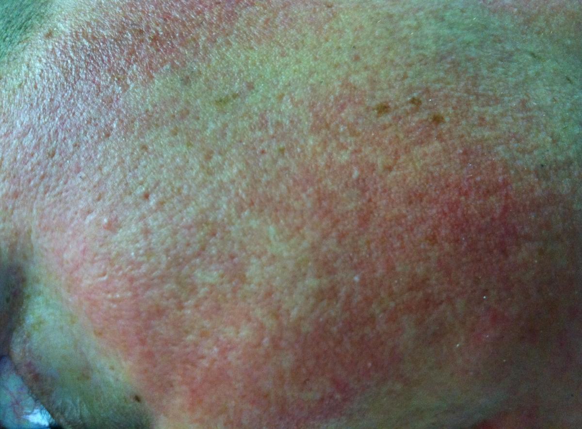  including chiggers and ...