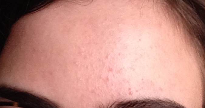 Small Bumps On My Forehead General Acne Discussion Community