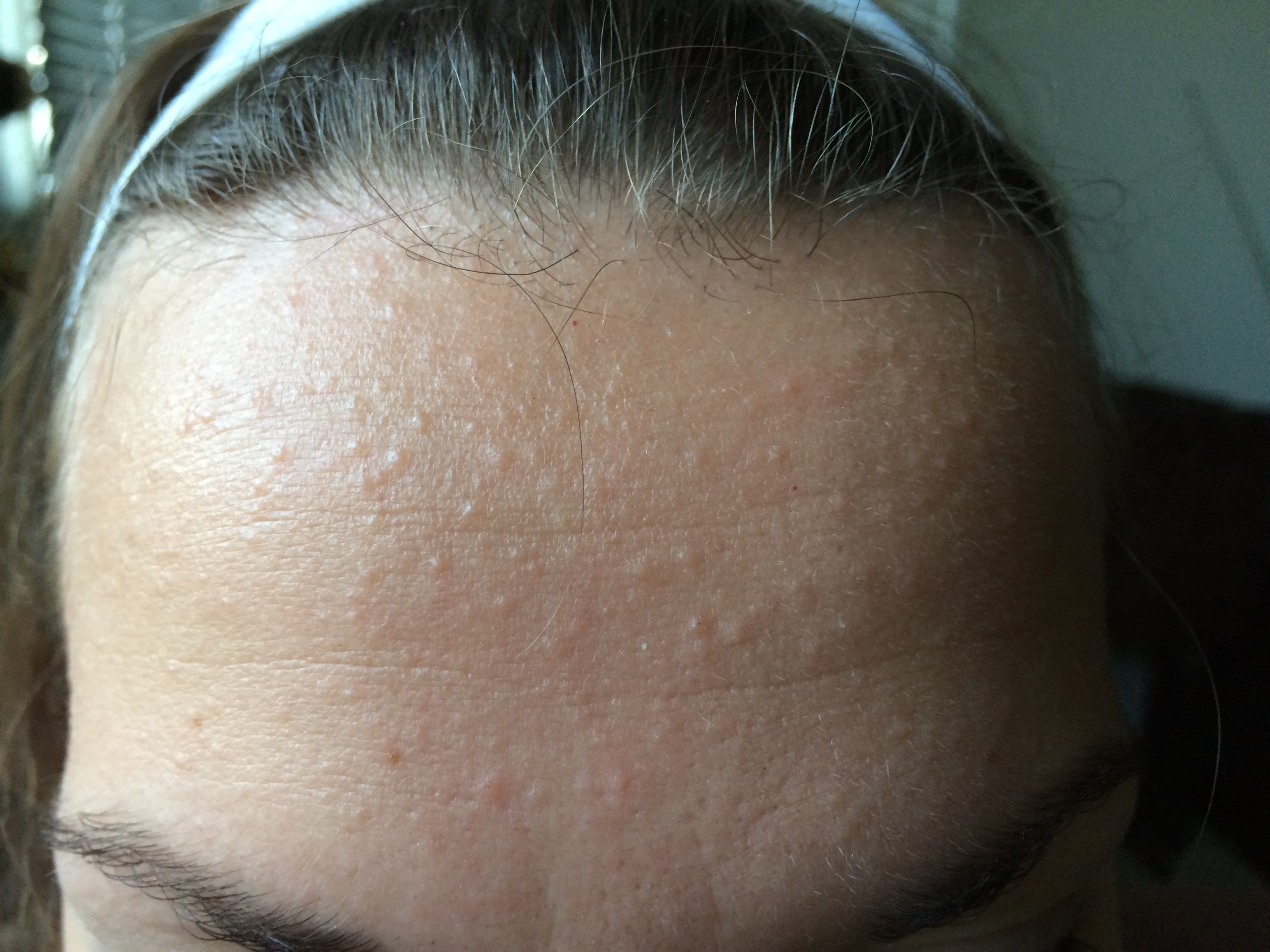 itchy bumps on forehead