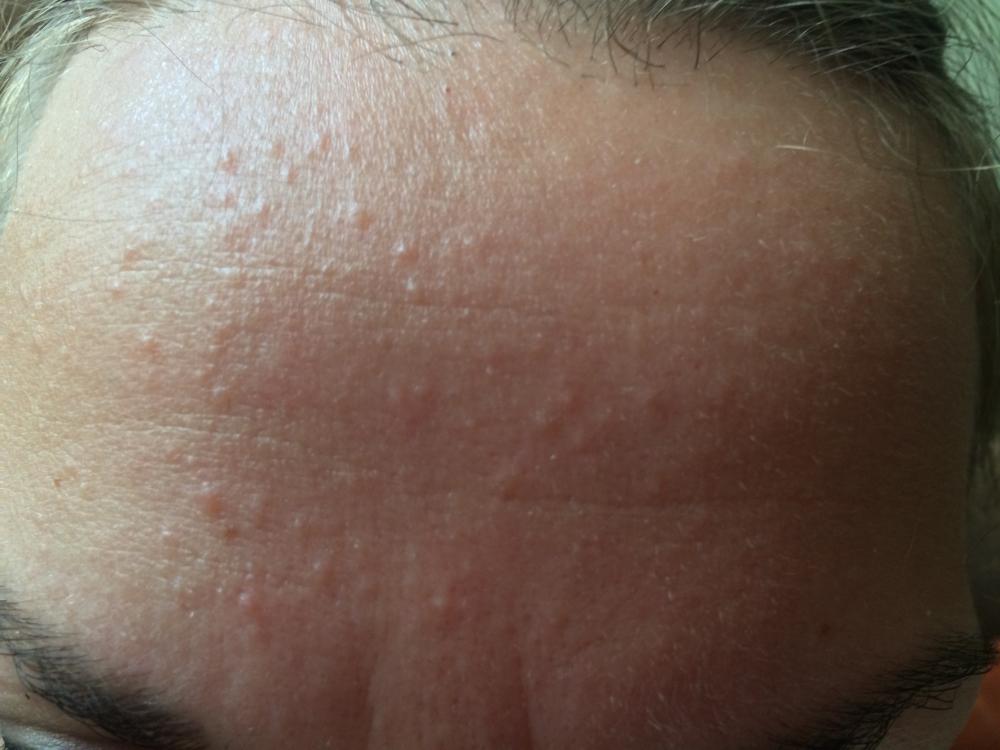 small red bumps on forehead