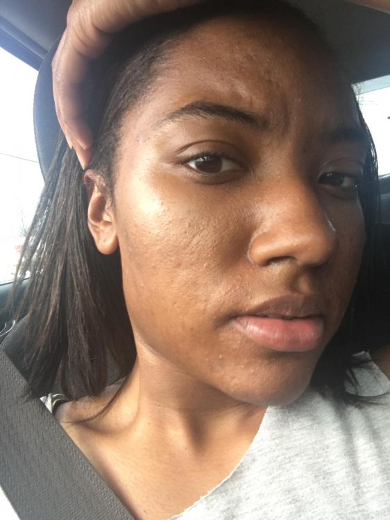 Water, Facial Wash, and Mosturizer - Over-the-counter acne Water, Facial Wash, and Mosturizer - Over-the-counter acne