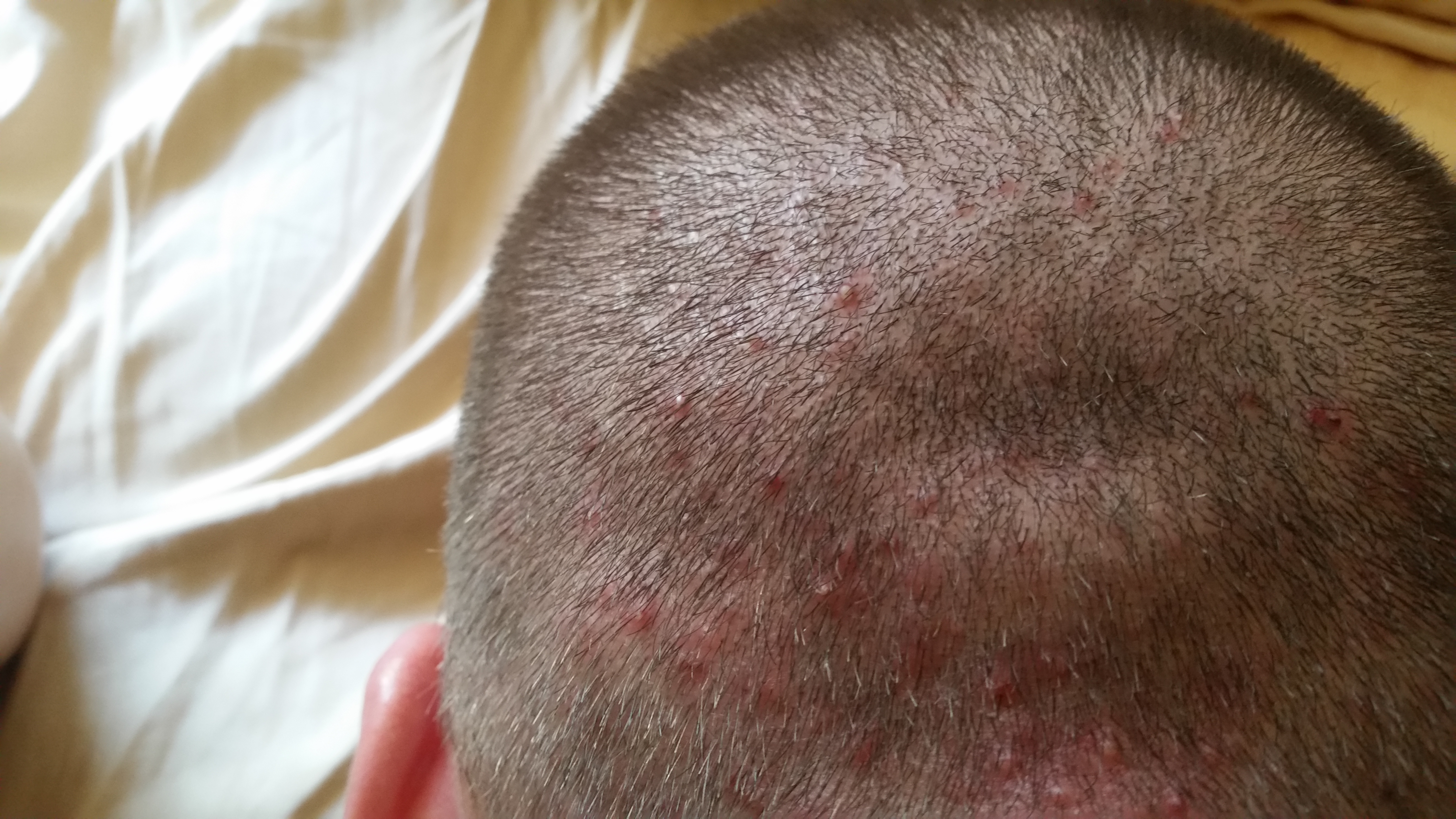 Scalp Acnefolliculitis Pictures General Acne Discussion