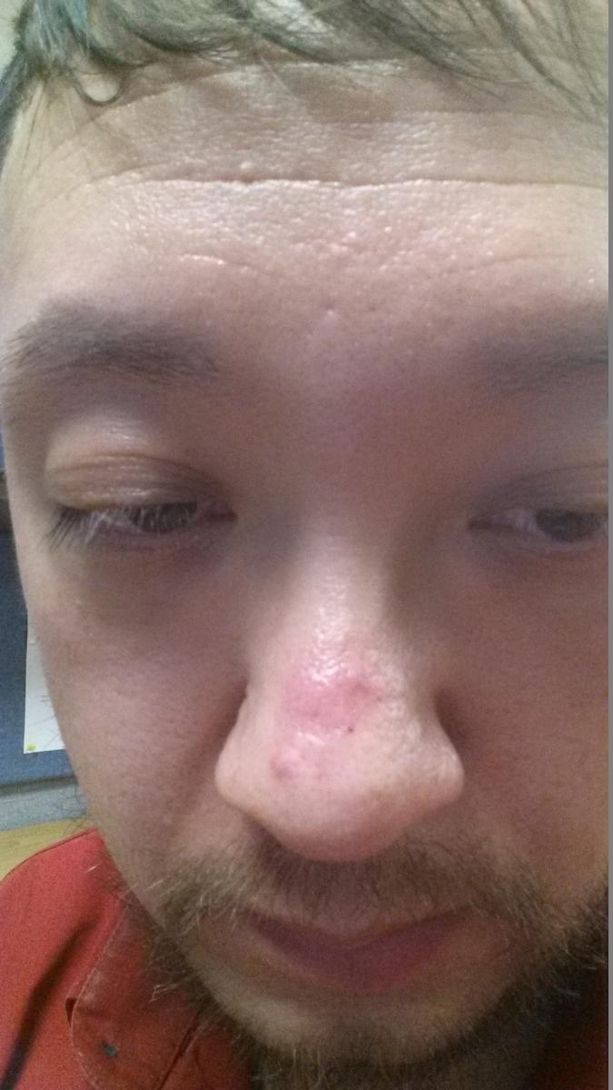 How do I treat a swollen nose?