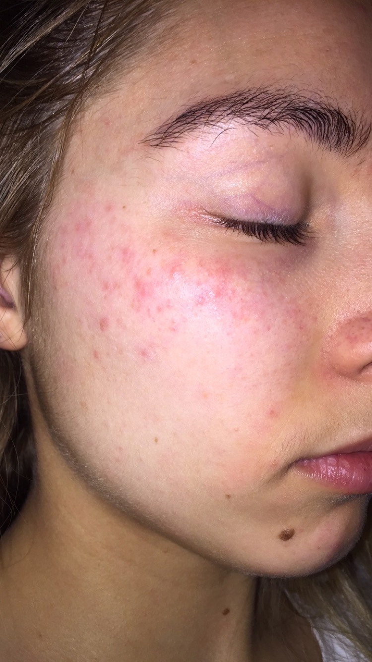 Small Red Acne On Face