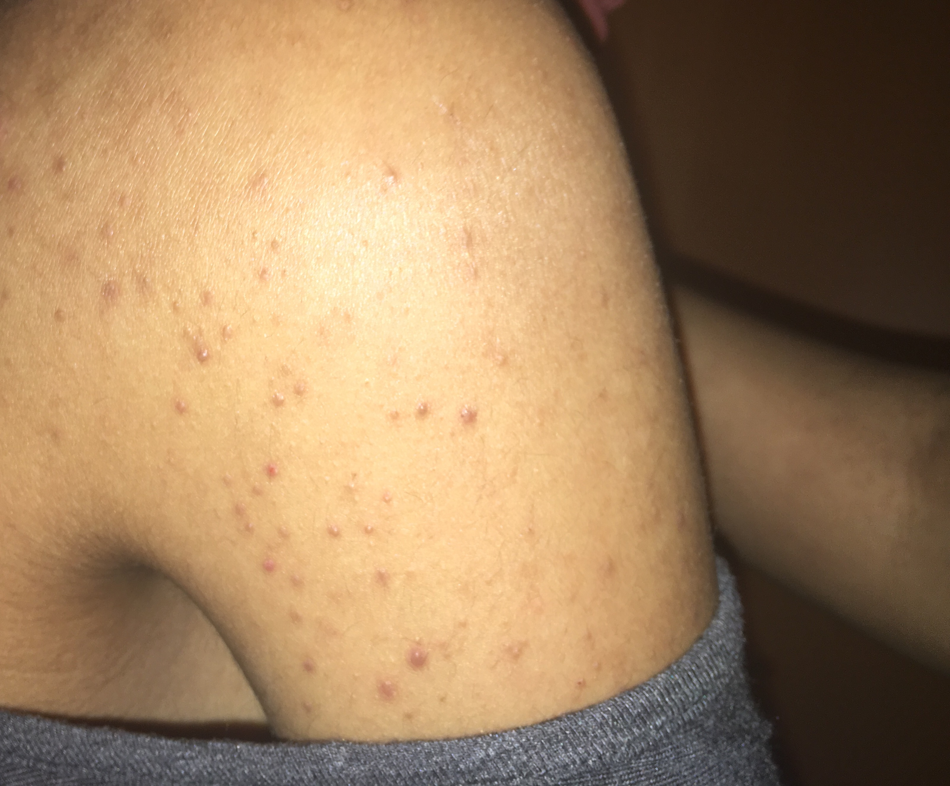 Pesky Acne On Shoulders HALP Back Body Neck Acne Acne Community