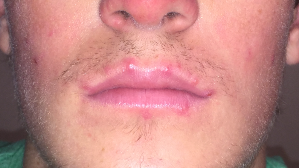 Multiple Pimples Around Edges Of Lips General Acne Discussion Acne 