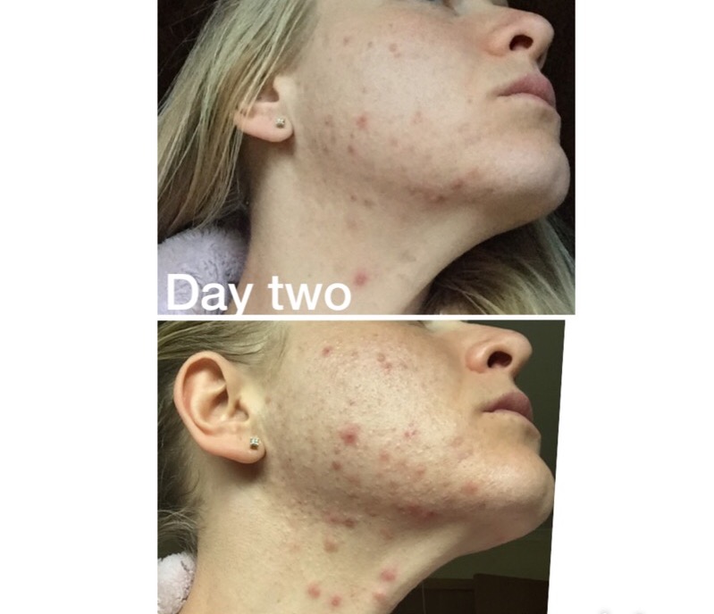 how long does it take for sulfamethoxazole to work for acne