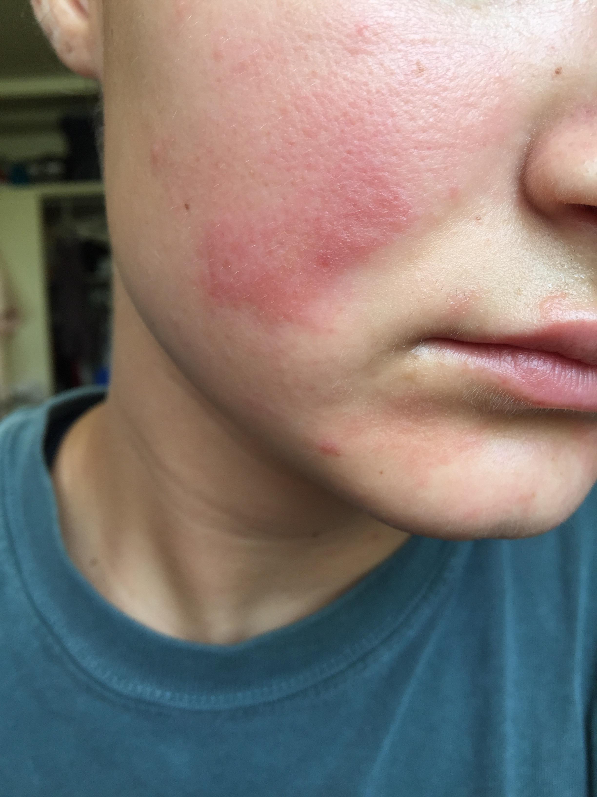 facial-rashes-what-s-the-diagnosis