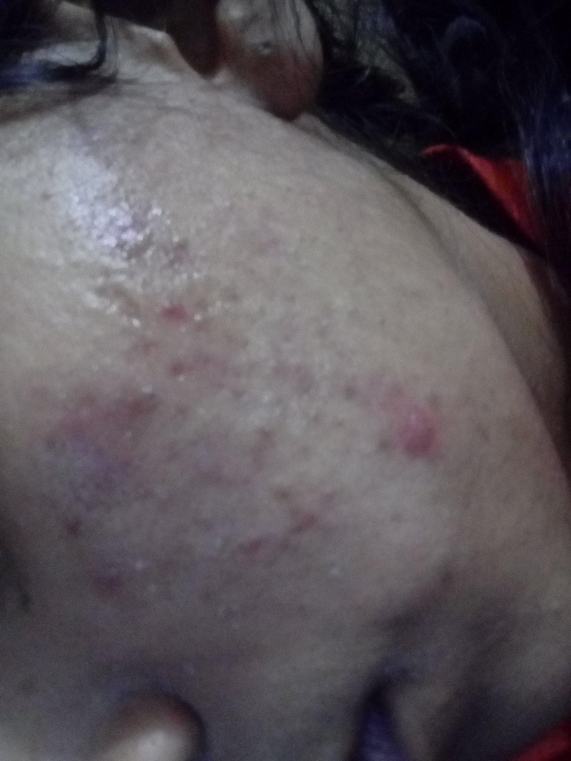 Domodex mite(rice grain size) causing acne on face ...