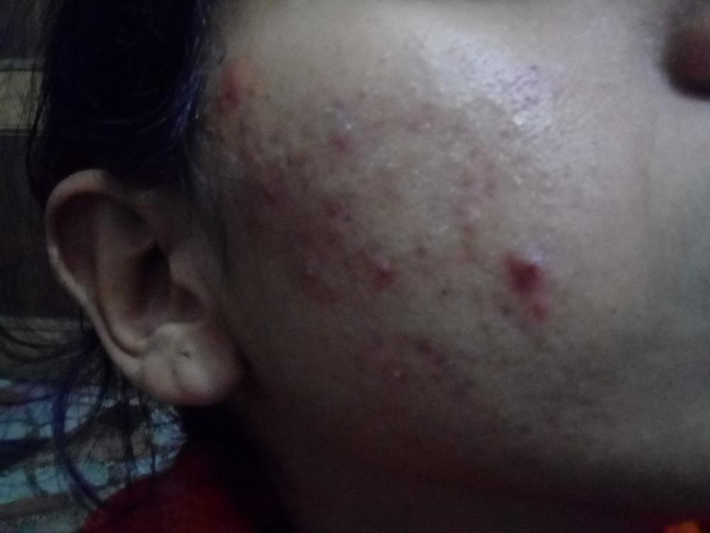  demodex present ...