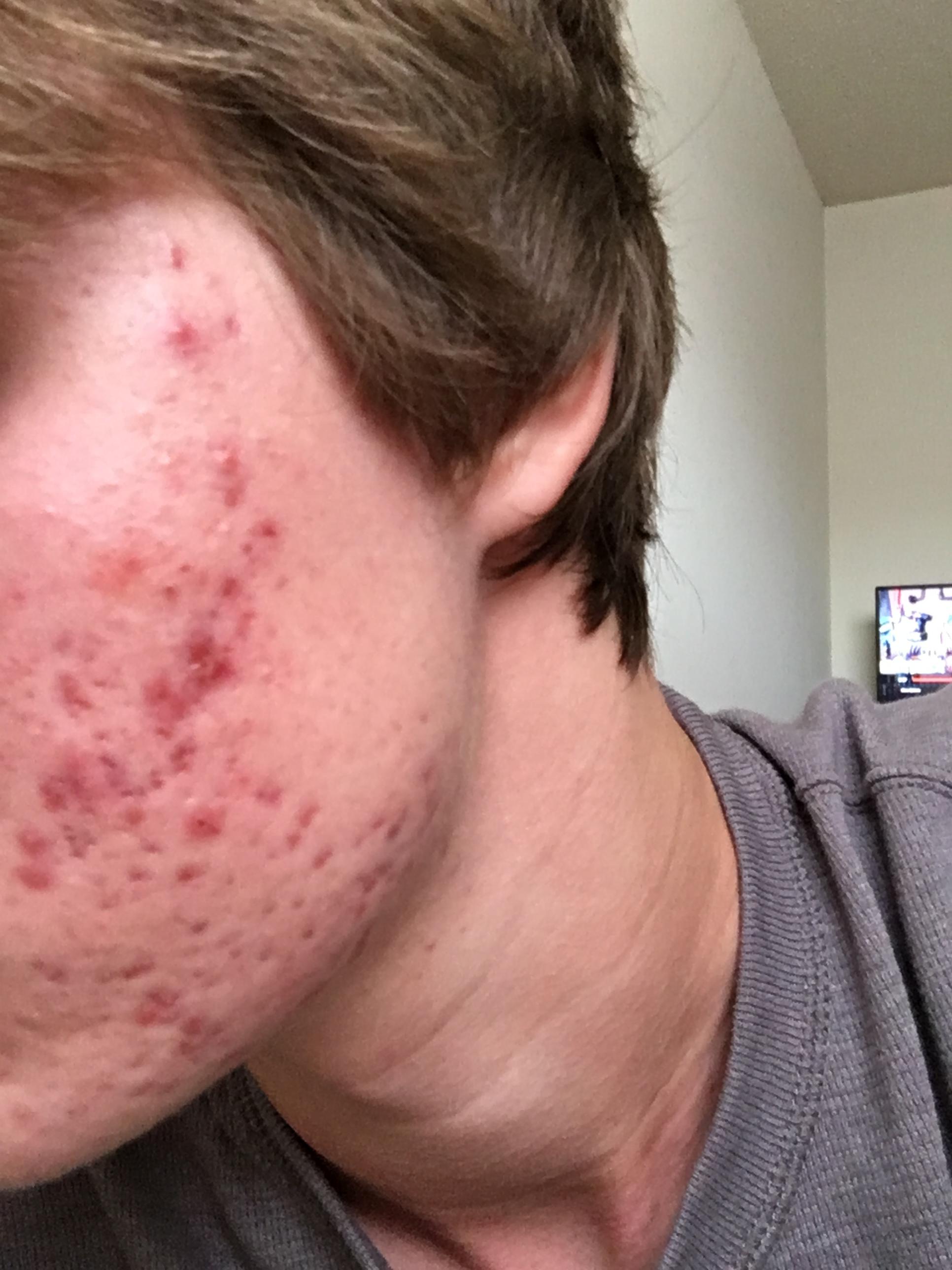 How Severe is my acne, and What can be Done to Help it? - General acne