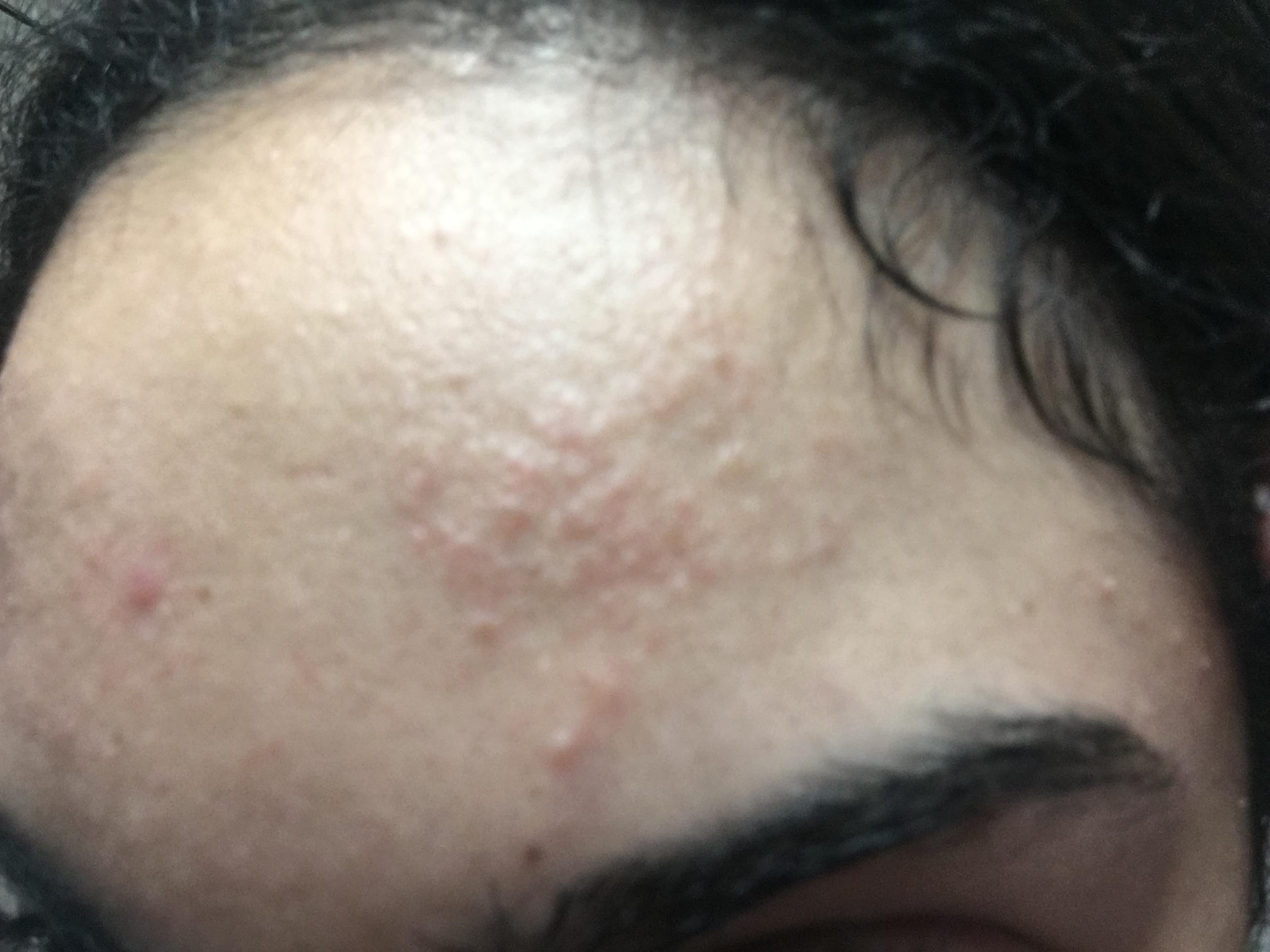 forehead-rash-or-acne-general-acne-discussion-acne-community