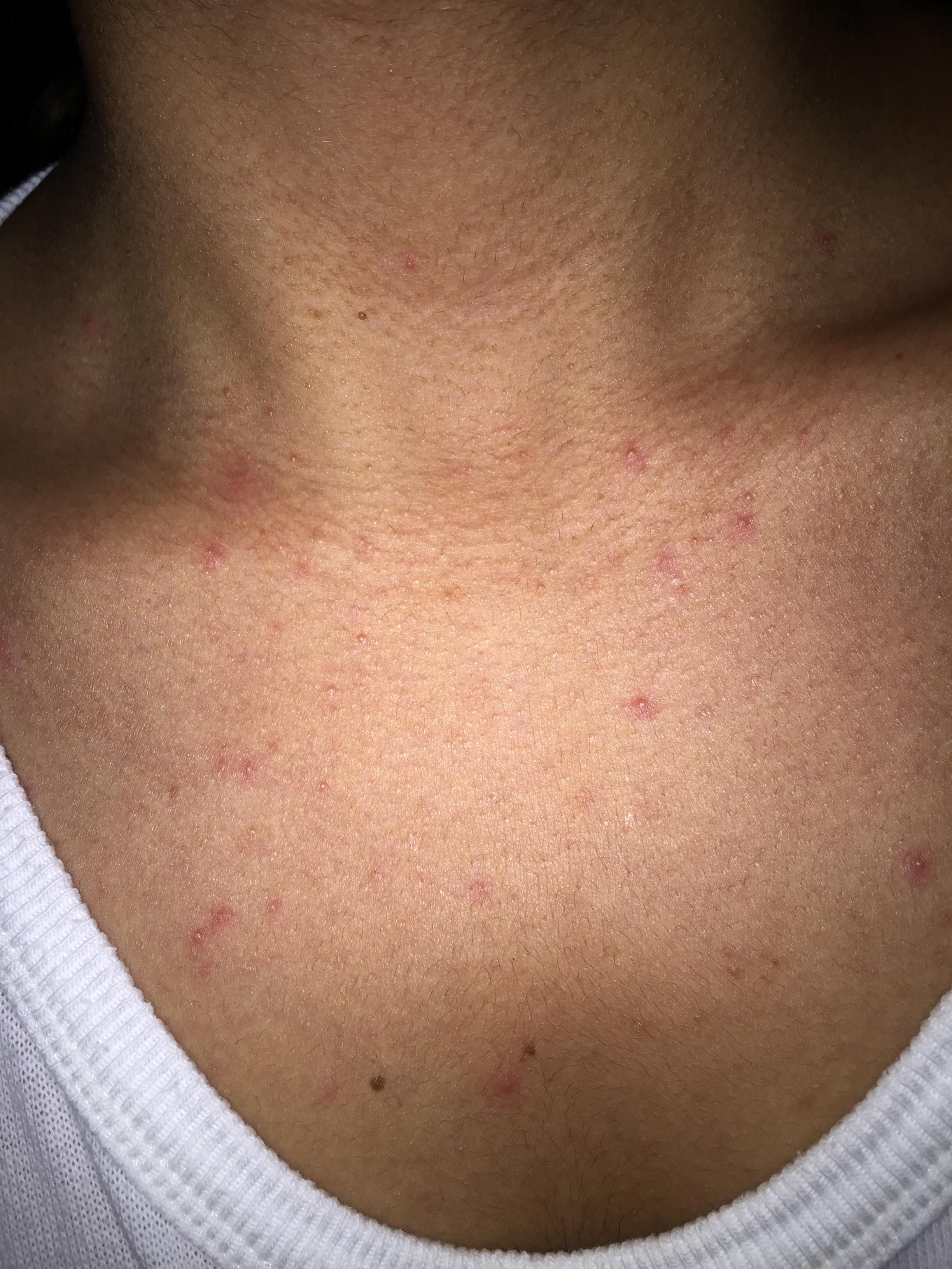 chest-acne-back-acne-back-body-neck-acne-acne-community