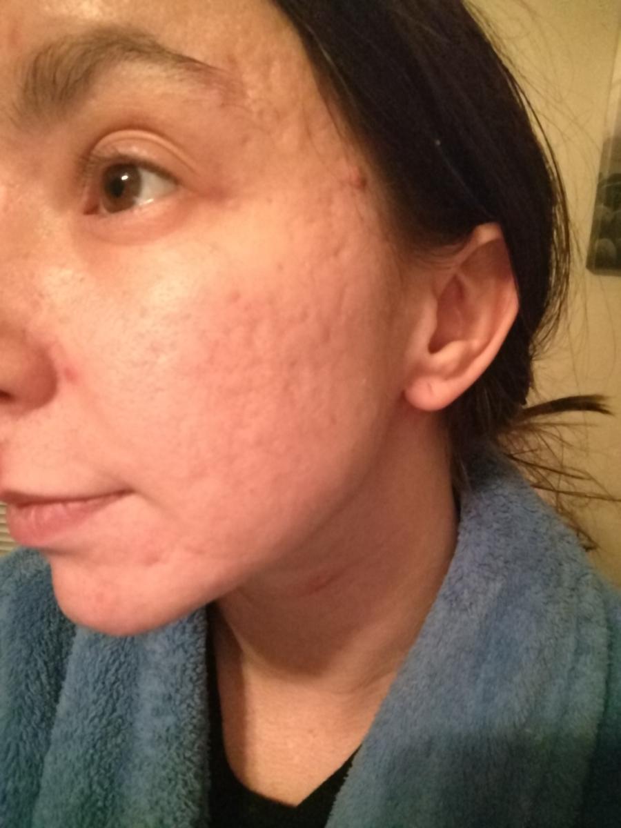 Week 3 - AHA & Retinol - Pictures & Videos - Acne.org Week 3 - AHA & Retinol - Pictures & Videos - Acne.org