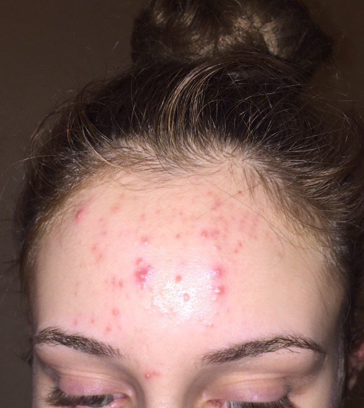 Red Marks After Spots Going Help Plspics Hyperpigmentation