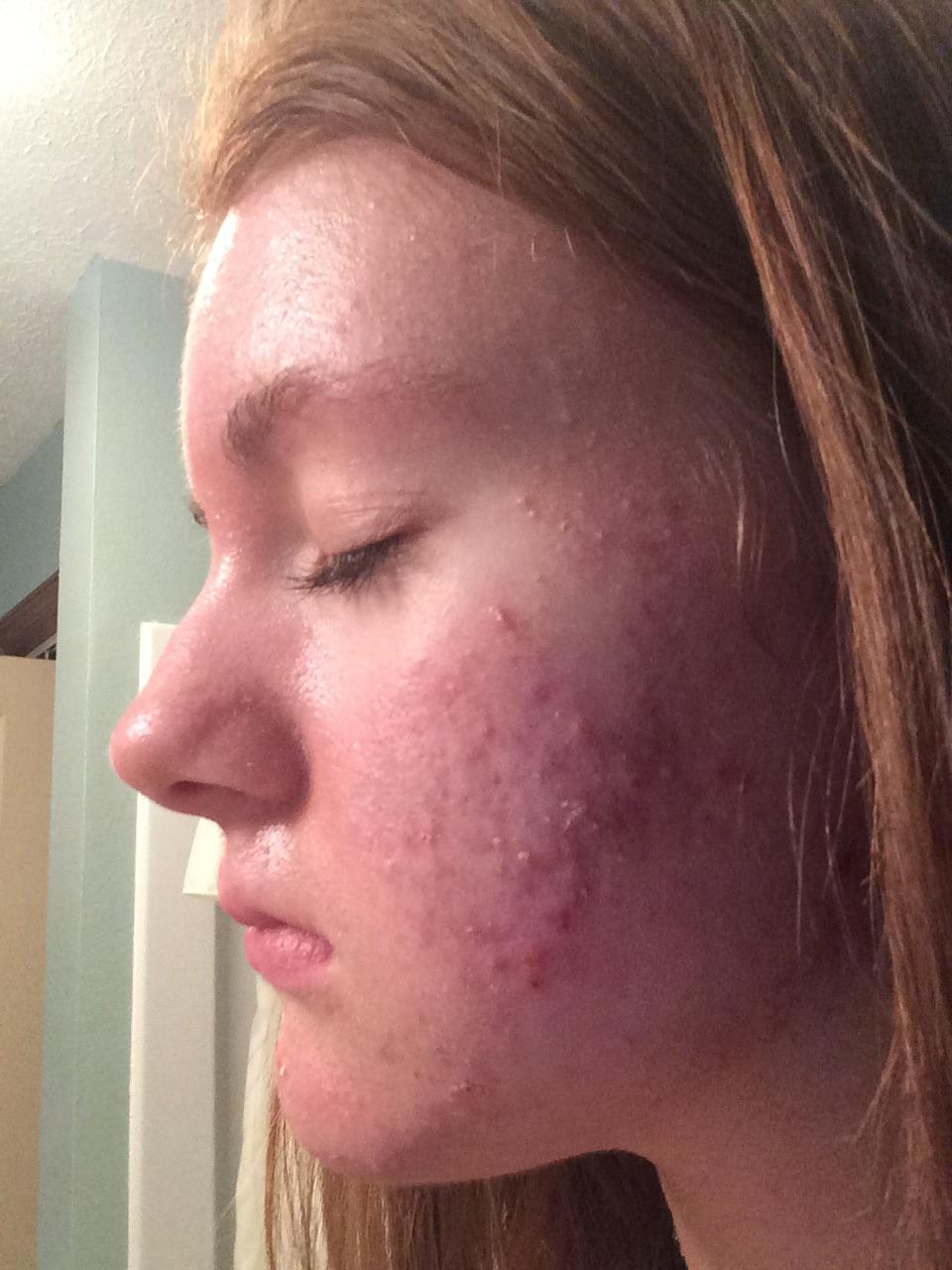 Cystic Acne Along Jawline