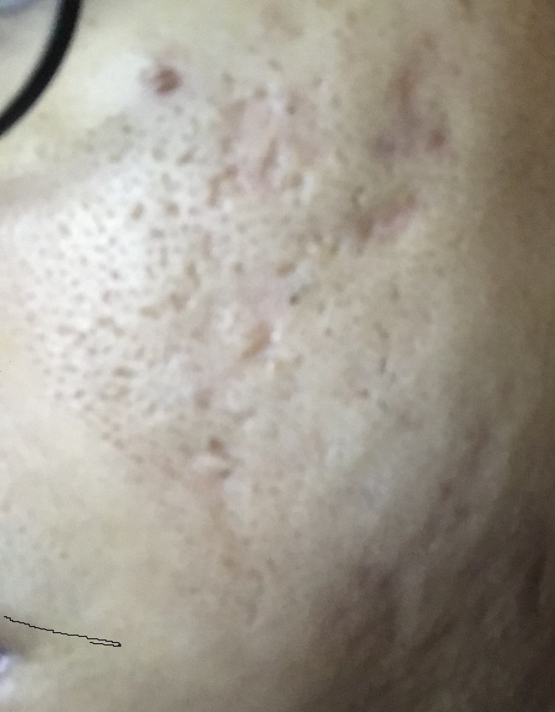 Help With Pitted Scars Hyperpigmentation Red Dark Marks Acne Org