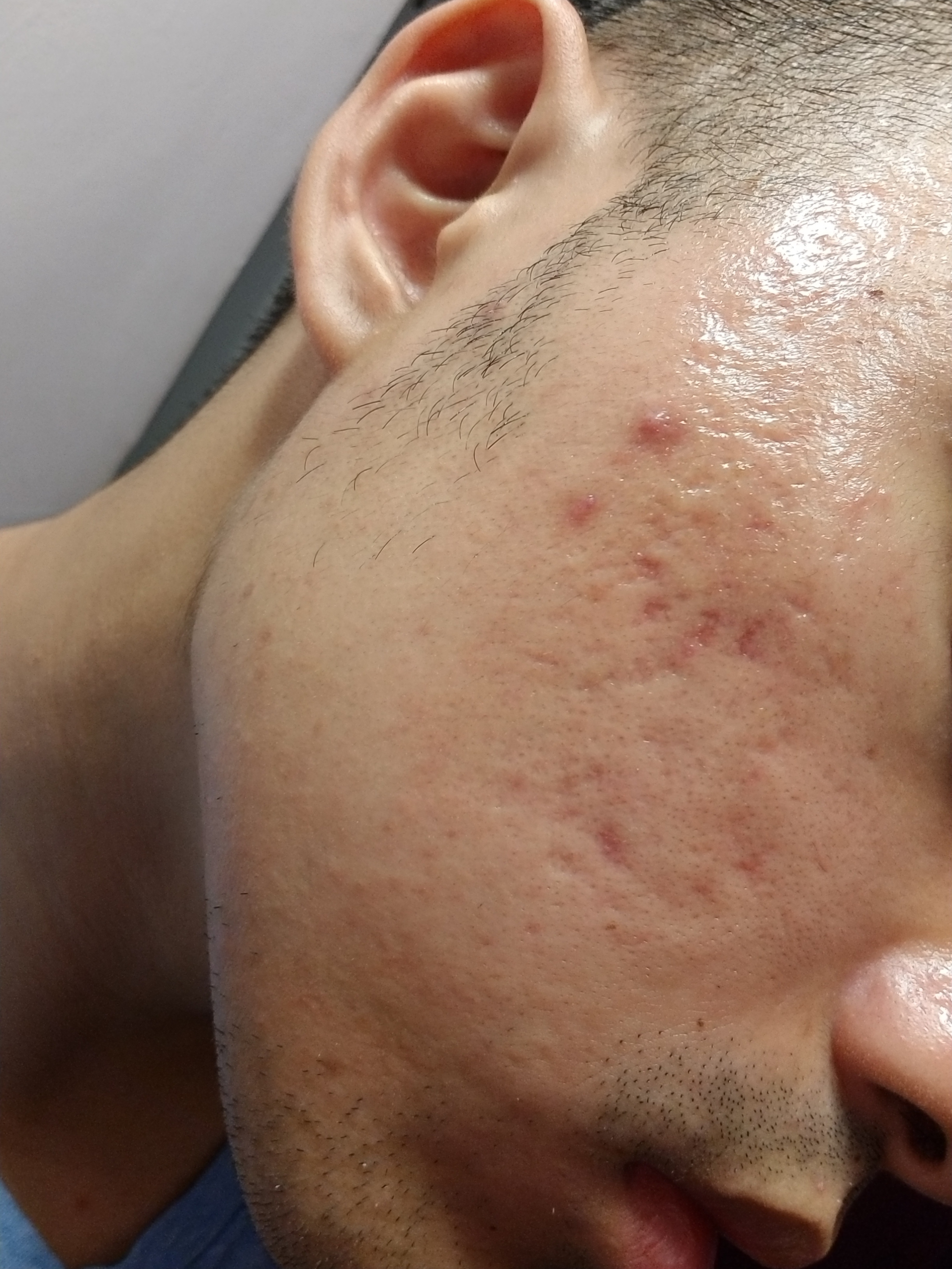 Acne Scars Too Severe Is There Any Hope For Me Scar Treatments