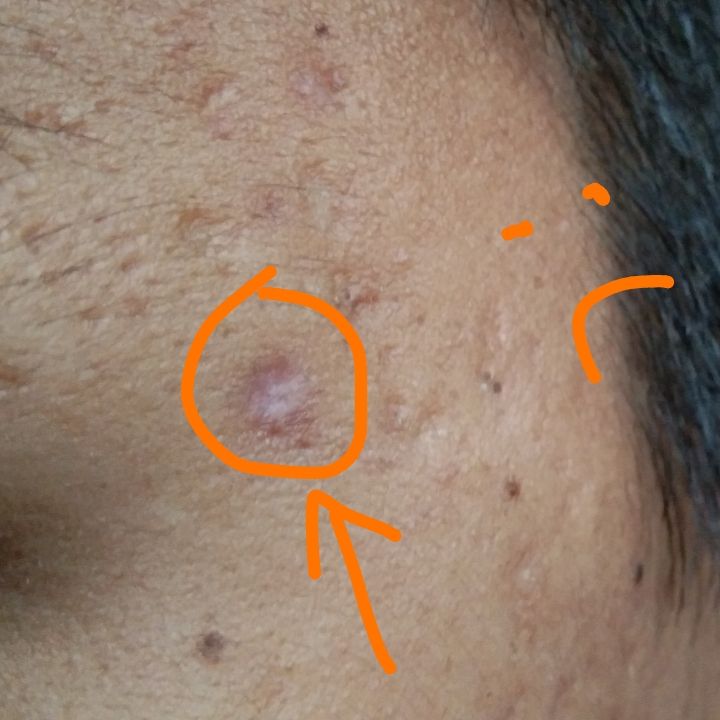 Help Please Tca Cross Hyperpigmentation Red Dark Marks Acne Org