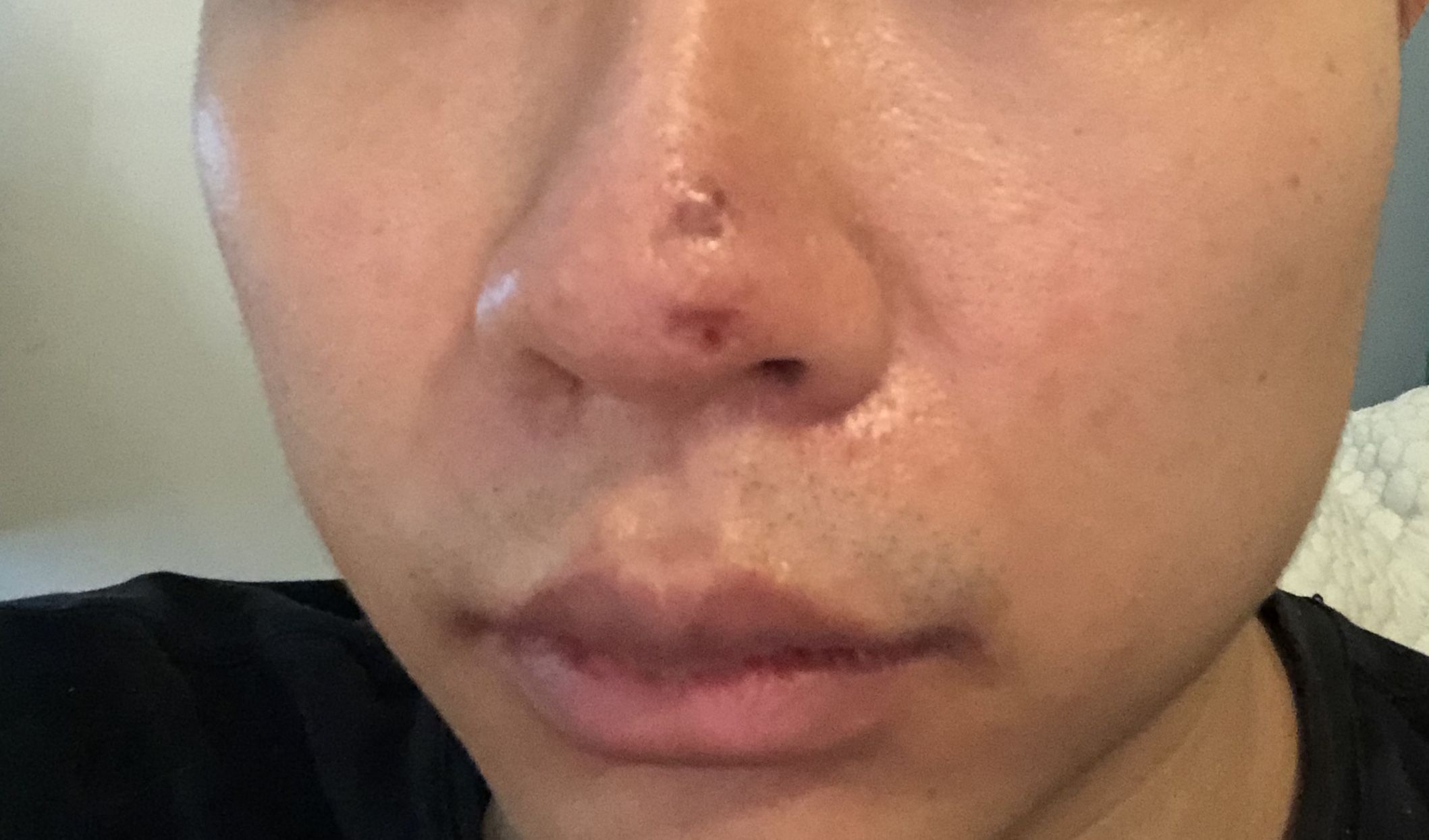 Acne Treatment - How Do I Tell It's Going?