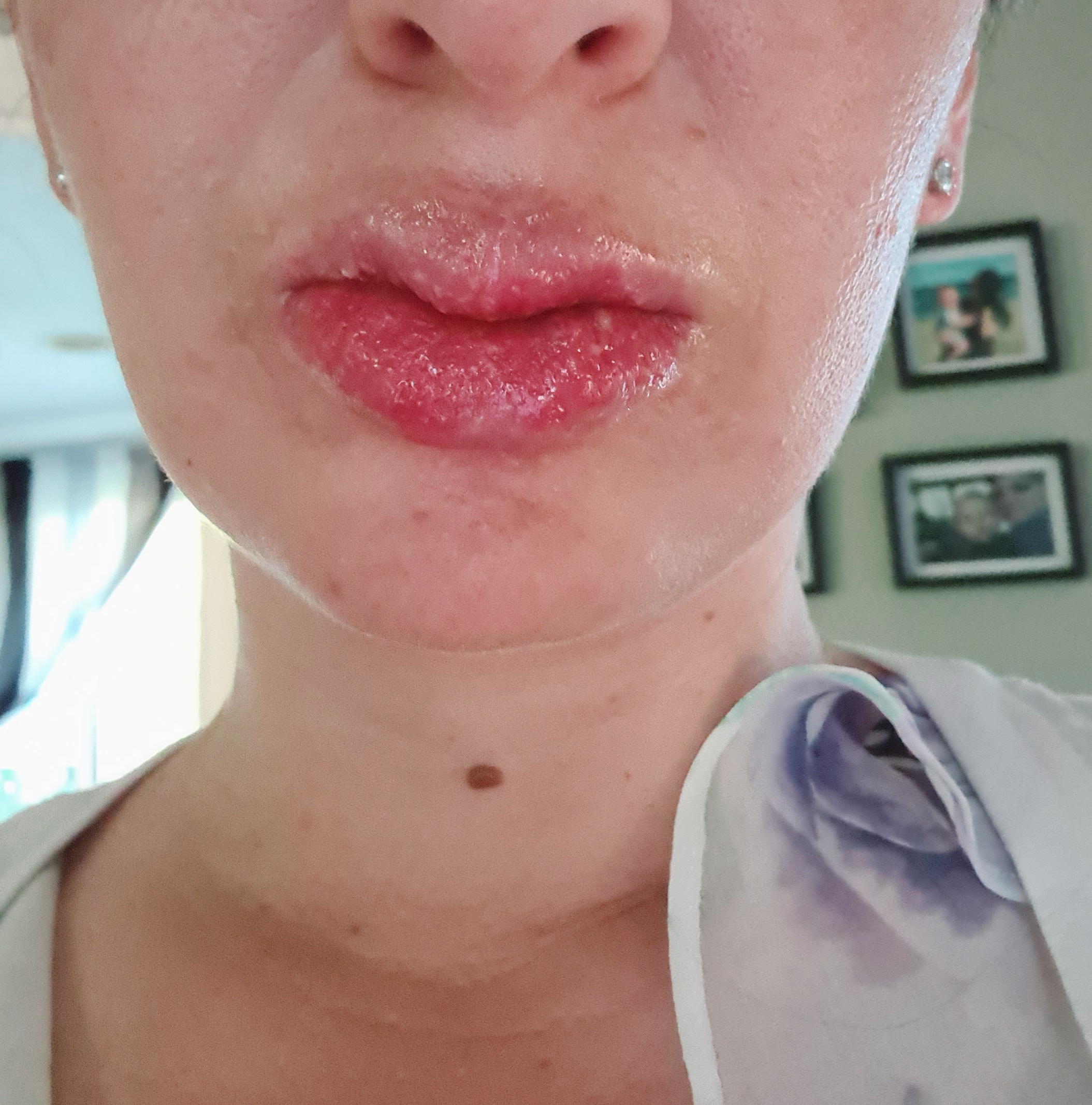 Allergic Reaction Blisters On Lips My Xxx Hot Girl