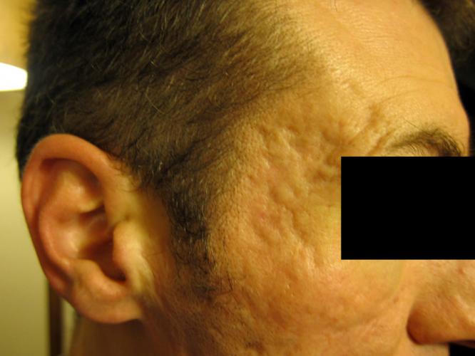 Recommended Treatment For Temple Scarring Scar Treatments