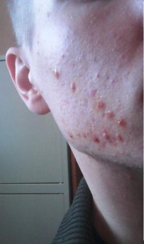 can diabetes cause cystic acne