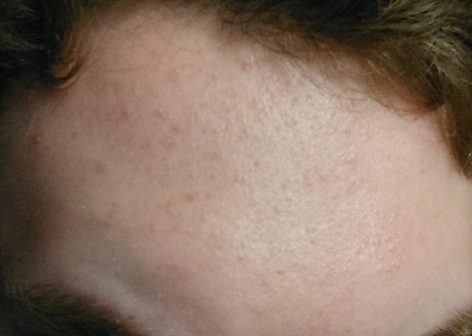 Tiny Bumps On Forehead Small Pimples Small Bumps On F Vrogue Co