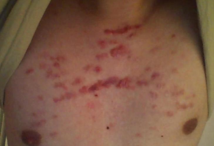 How Do I Get Rid Of Keloid Acne Scars On My Chest Scar Treatments