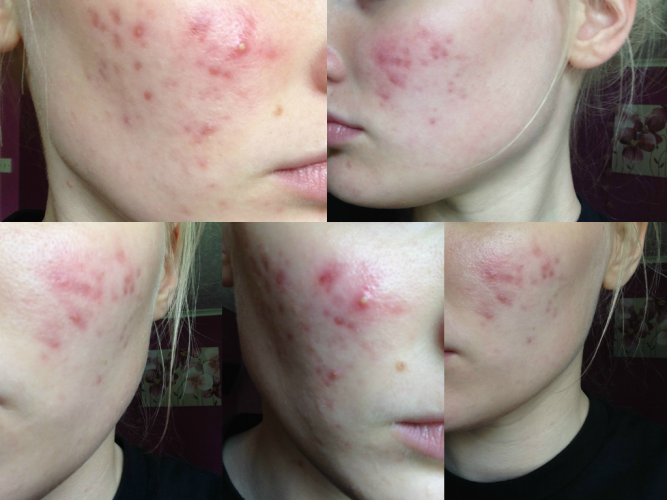 red-acne-scarring-on-cheeks-scar-treatments-acne-community