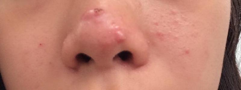 How Can I Get Rid Of Big Pus Filled Pimples On Nose General Acne 