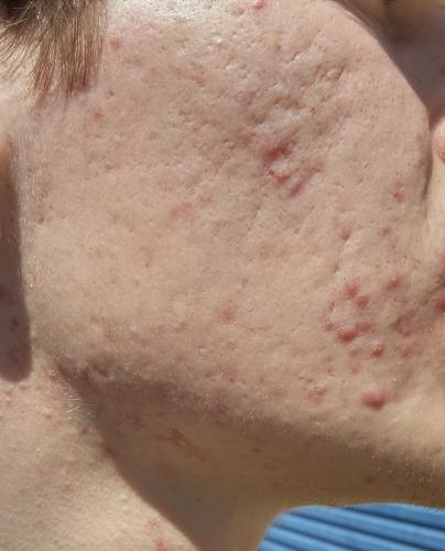 scar treatments after accutane