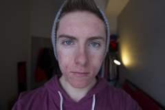 Low Dose Accutane And Actors