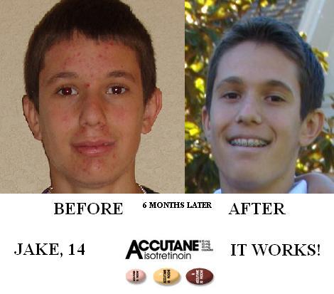 Accutane (isotretinoin) logs - Before and after - ACCUTANE WORKS.JPG ...