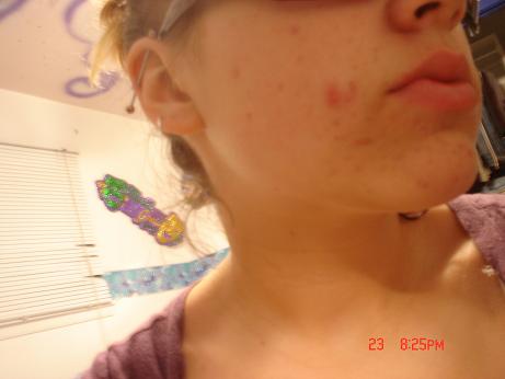 Jessy's acne 003.jpg