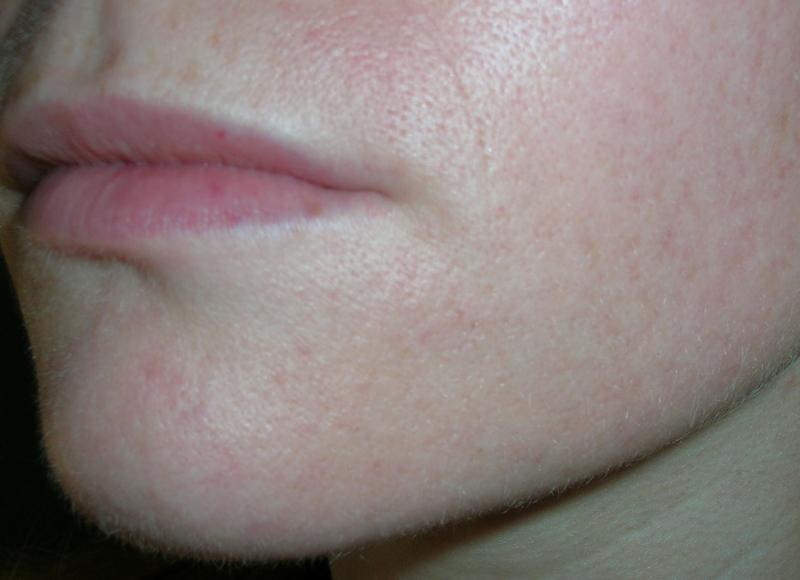 My acne progress - 9 months later!