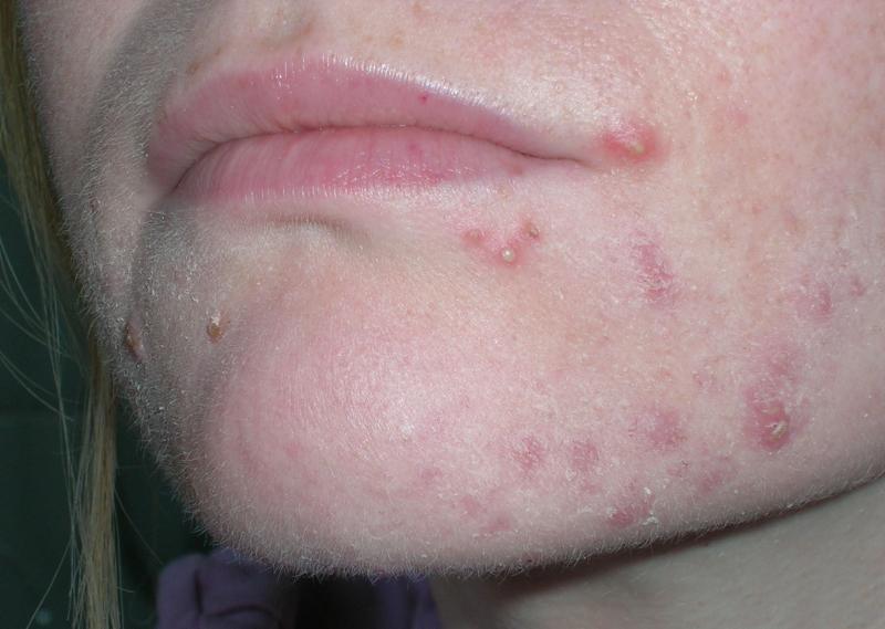 My acne progress - Day 1