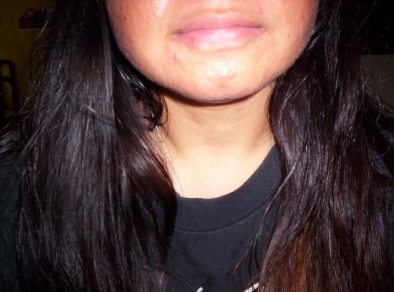 Chin with zits