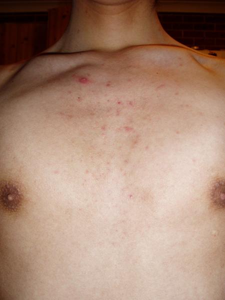 Chest day 13 roaccutane (40mg/day)