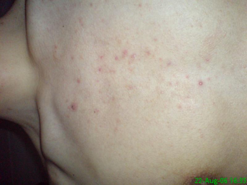 Day 19 Roaccutane (40mg/day) chest area